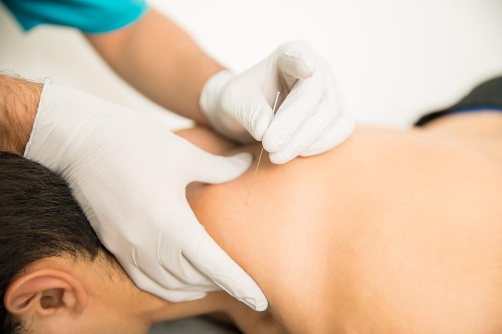 Dry needling treatment in Leduc